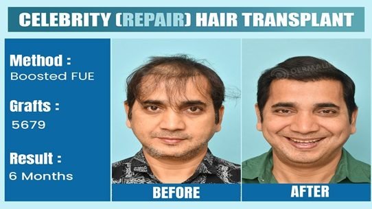 Ultimate-Guide-to-Choosing-the-Best-Hair-Transplant-Clinic-in-Delhi-NCR Ultimate-Guide-to-Choosing-the-Best-Hair-Transplant-Clinic-in-Delhi-NCR