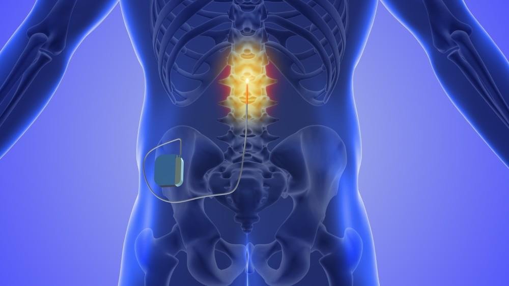 Say Goodbye to Chronic Pain with Spinal Cord Stimulation